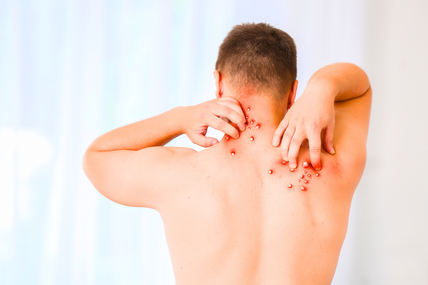 جدري القردة