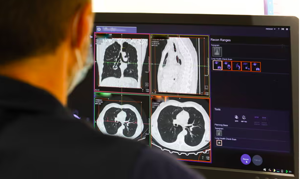 سرطان الرئة